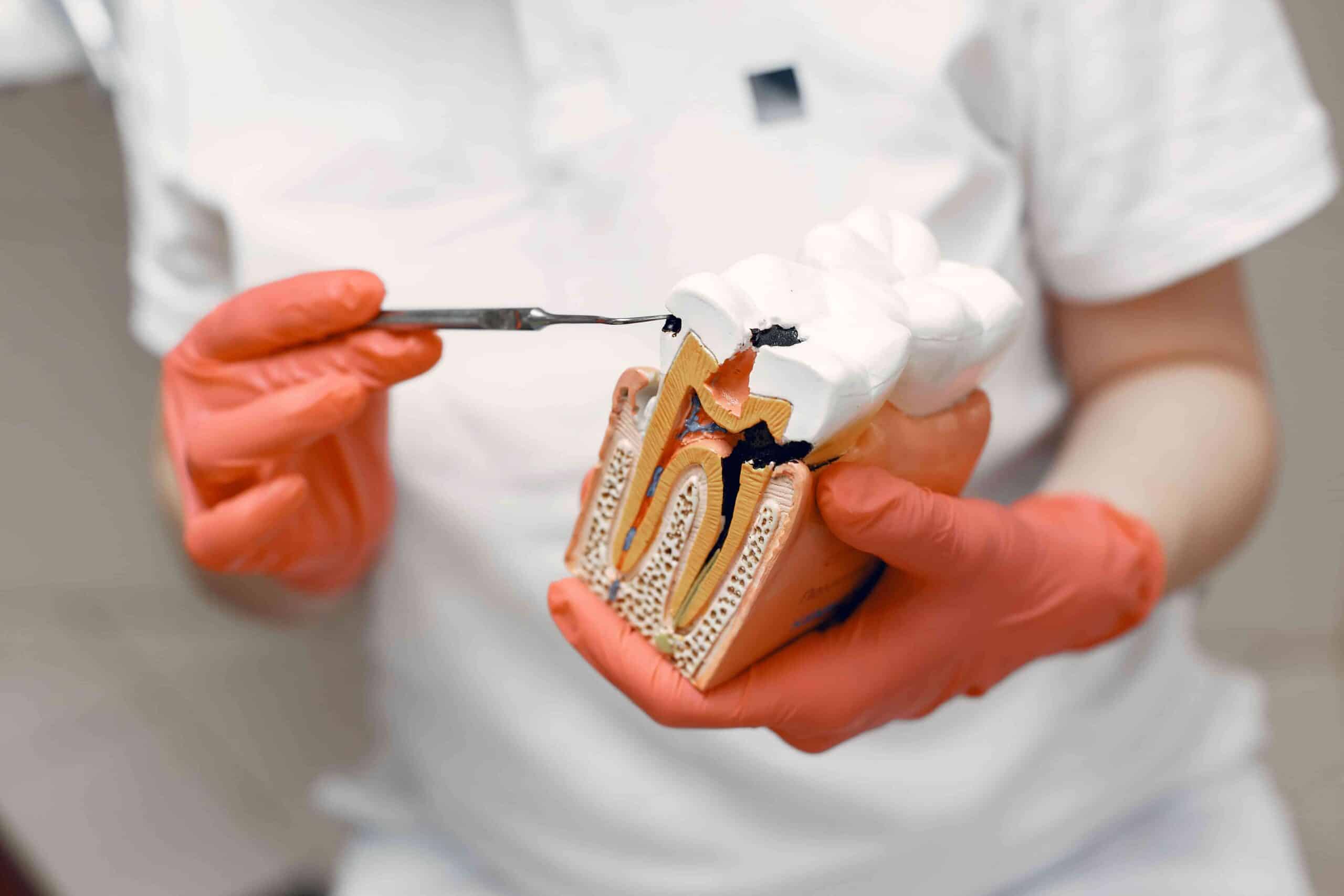 Quick Fixes for a Broken Tooth at Home Until You See a Dentist 4 dentist showing model teeth for decay